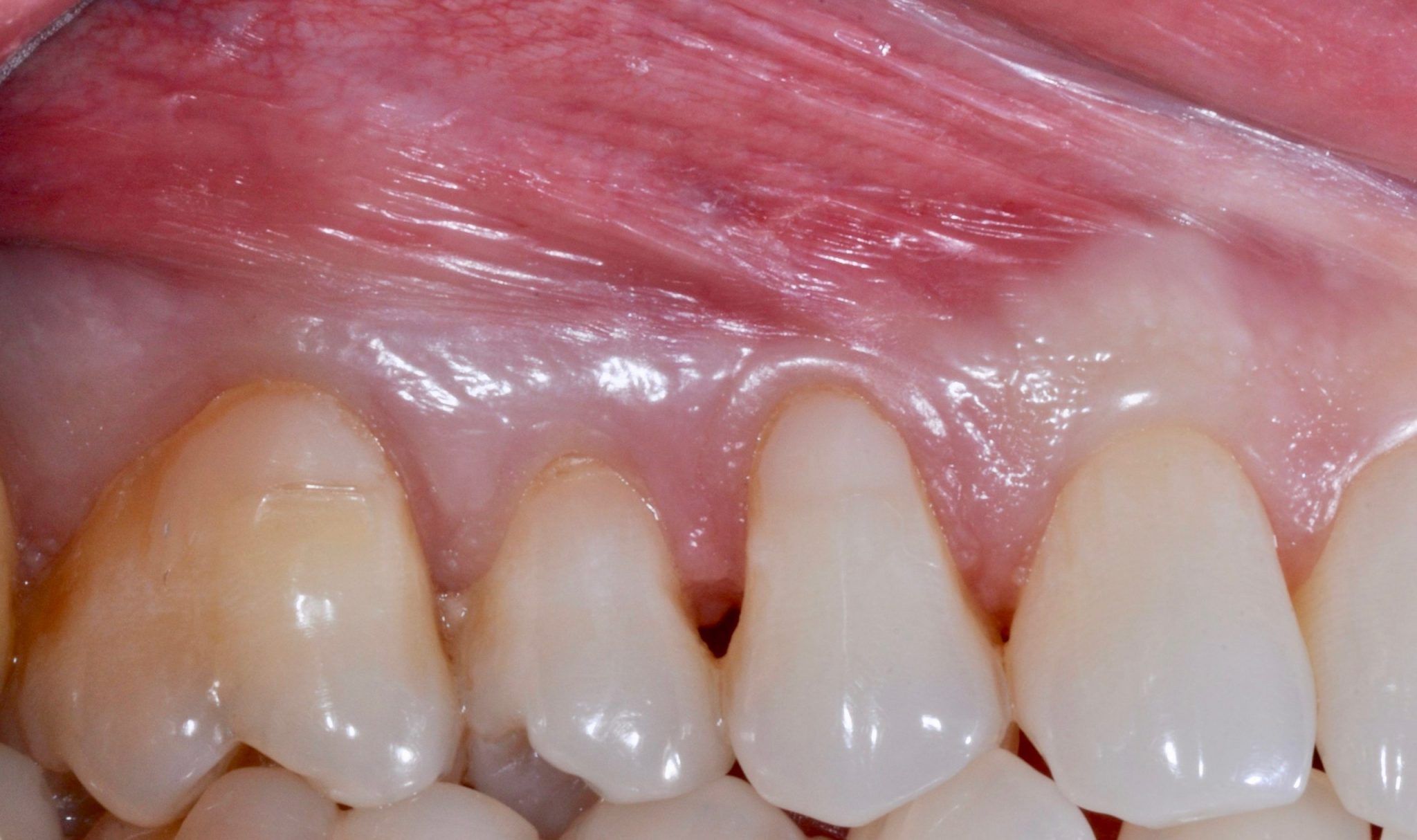 Gingival (Gum) Grafting Dental Implants & Periodontics of CT