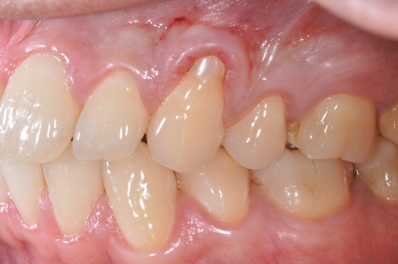 Gingival (Gum) Grafting Dental Implants & Periodontics of CT