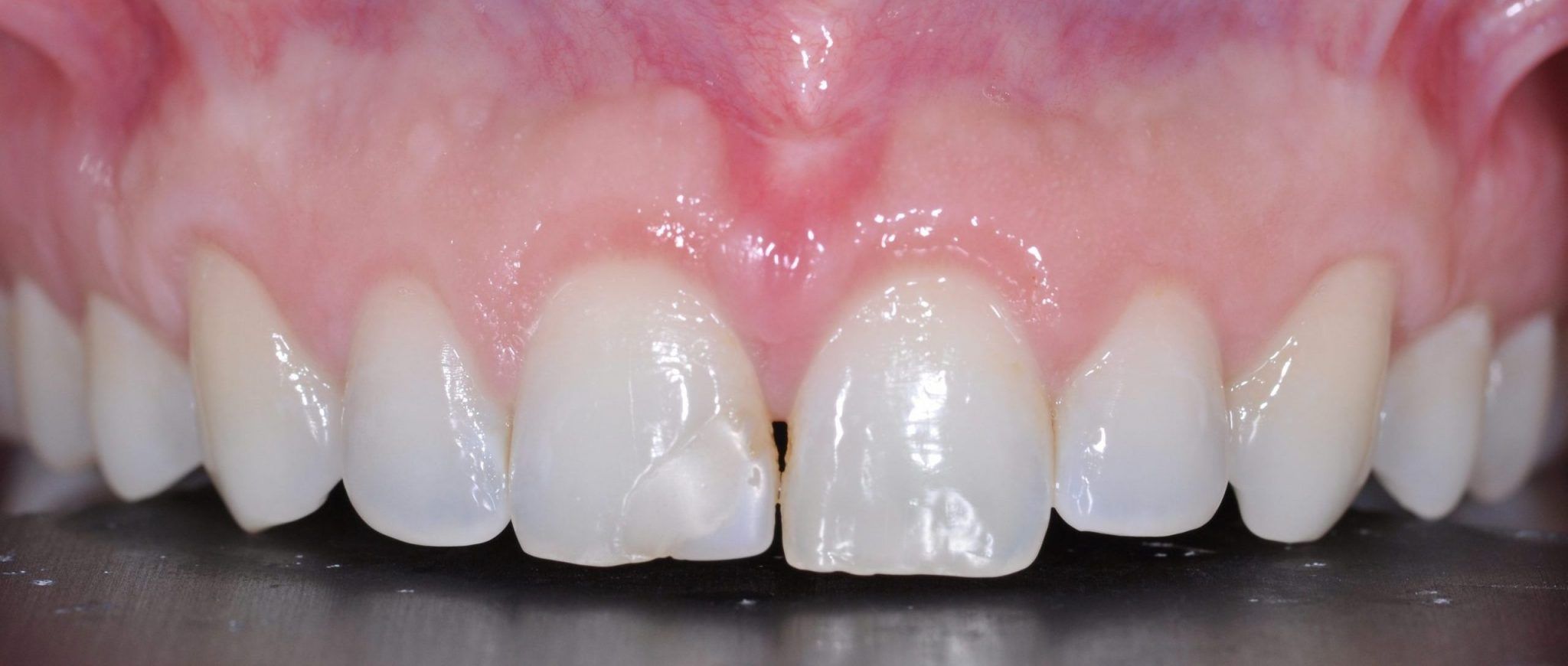 Crown Lengthening – Dental Implants & Periodontics of CT