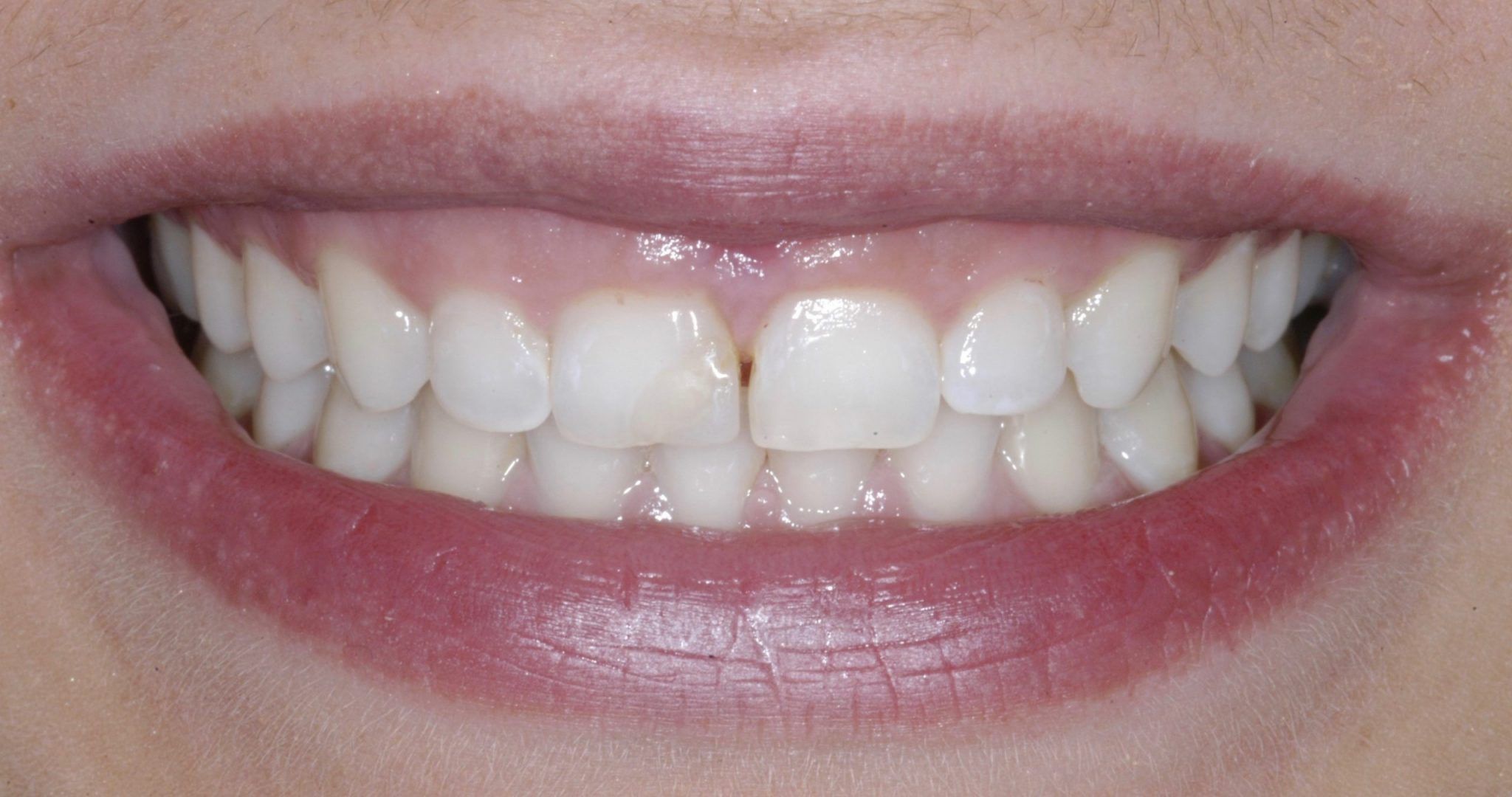 crown-lengthening-dental-implants-periodontics-of-ct