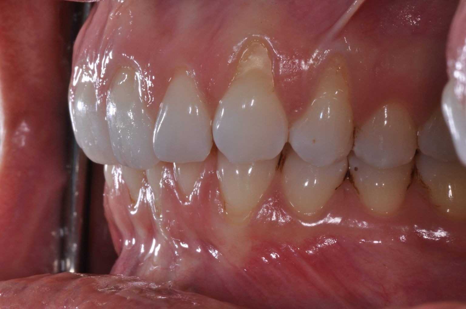 Gingival (Gum) Grafting Dental Implants & Periodontics of CT Gingival (Gum) Grafting Dental Implants & Periodontics of CT