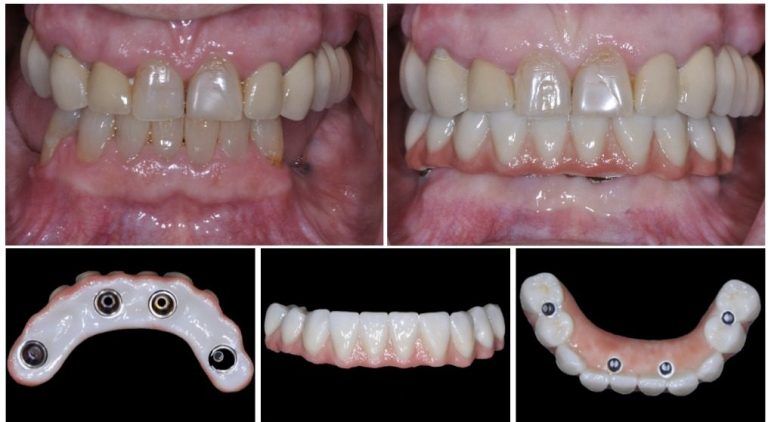 Full Arch Options “All on Four” – Dental Implants & Periodontics of CT