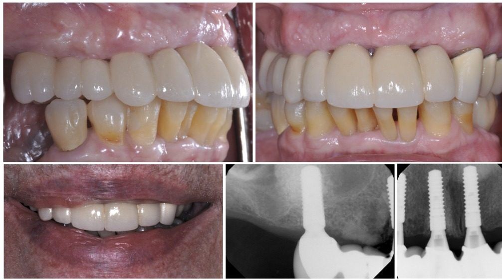 Full Arch Options “All on Four” – Dental Implants & Periodontics of CT