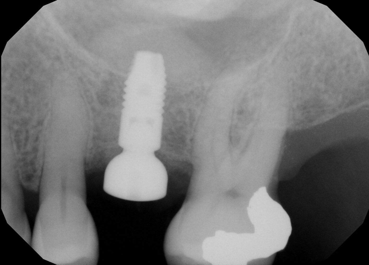Sinus Elevation/Lift Dental Implants & Periodontics of CT